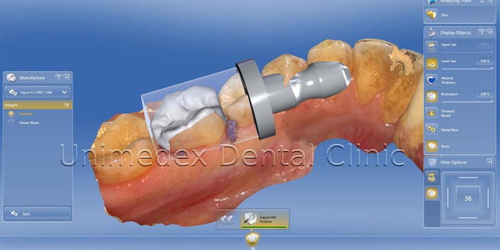 tooth inlay